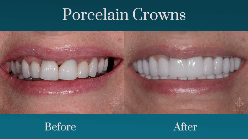 full porcelain crowns before a